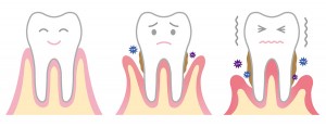 treatment_of_periodontal_disease_img001
